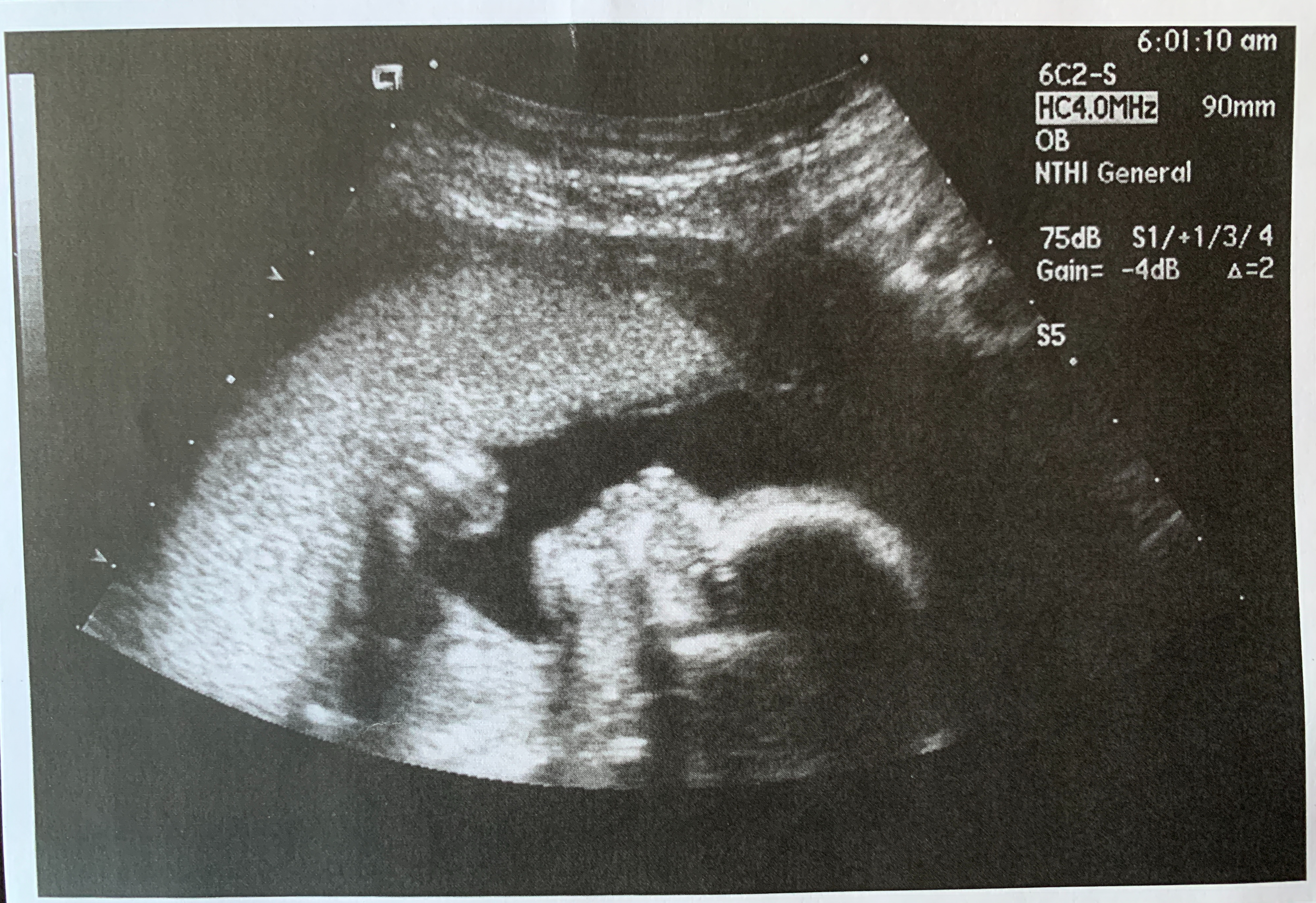 Season 1: Quinn’s Sonogram (Double).